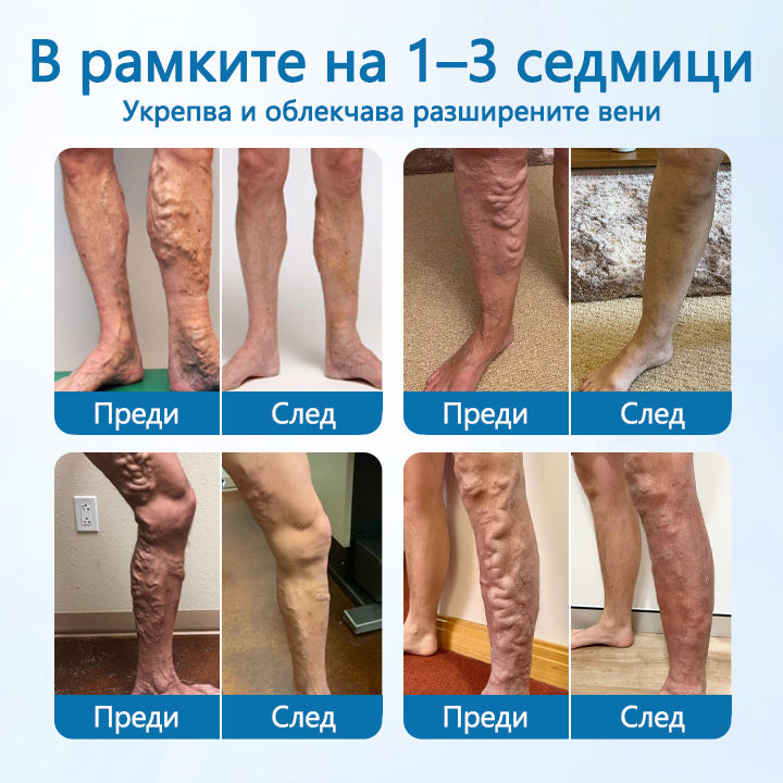 Timilk® VeinGuard Herbal Spray-Клинично доказано е, че премахва разширените вени само за 7 дни!✅