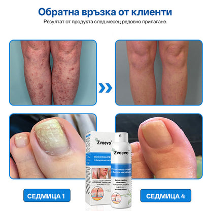 Zvoevo® Магнезиев билков спрей  – облекчение при псориазис, екзема, интимни бактериални инфекции, акне и тъмни петна📦