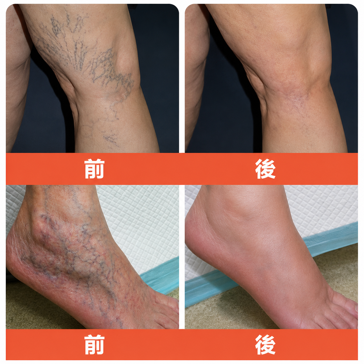 ☘️【厚生労働省認可・GMP準拠】Zvoevo® Vein Ease マイクロニードルケアパッチ（クモ状静脈・静脈瘤・むくみ・脚の疲れに）📦