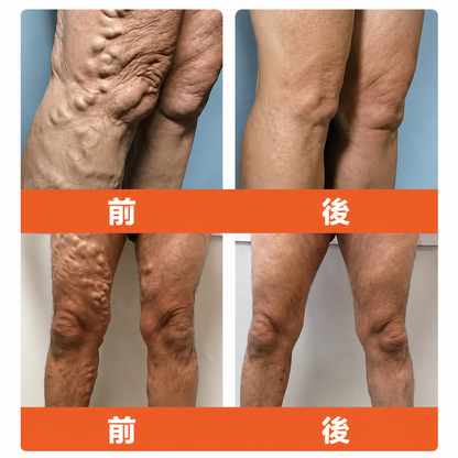 ☘️【厚生労働省認可・GMP準拠】Zvoevo® Vein Ease マイクロニードルケアパッチ（クモ状静脈・静脈瘤・むくみ・脚の疲れに）📦
